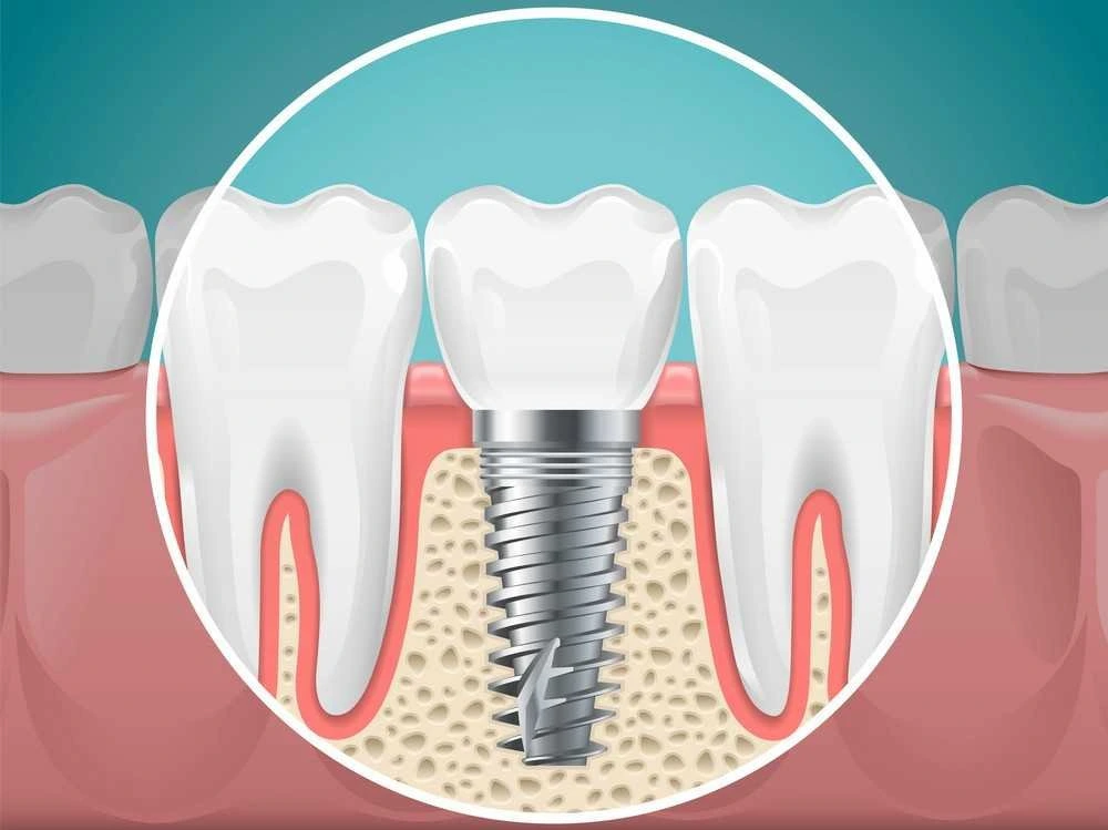 Dental Implants: A Permanent Solution to Missing Teeth