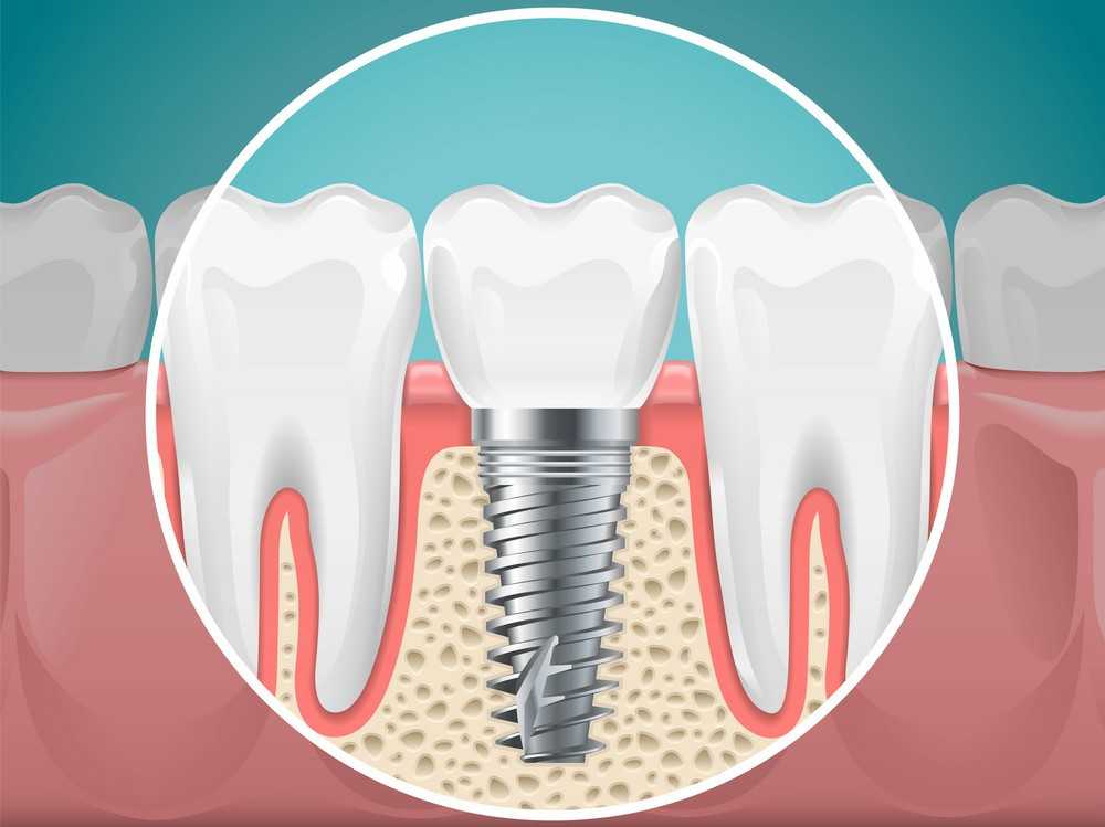 Dental Implants: A Permanent Solution to Missing Teeth
