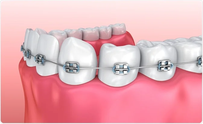 Dental Braces: What Are They, What Are Their Benefits, and How to Get a Perfect Smile
